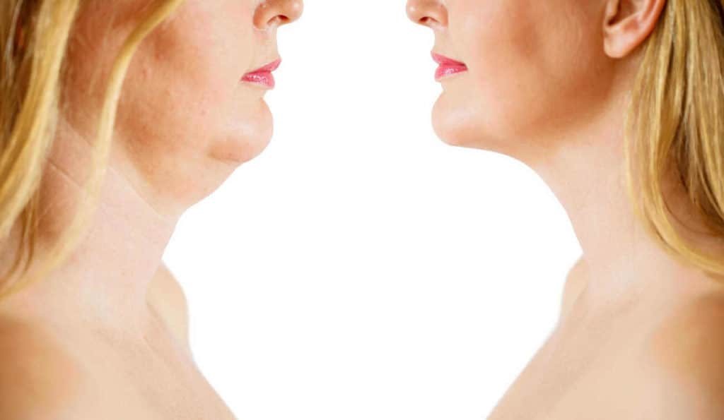 Double Chin treatment Deanshanger before and after results