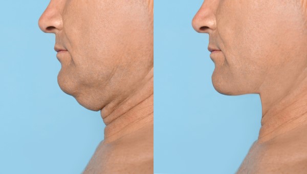 Which Non-Surgical Treatments Work Best for Jowls and Loose Skin Deanshanger?