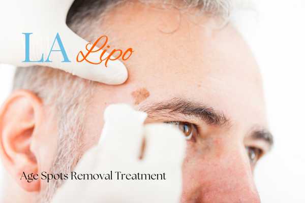 What Are the Most Effective Treatments for Age Spots Deanshanger?