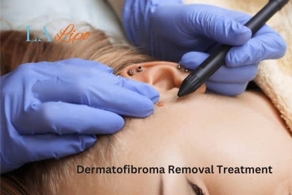 Dermatofibroma Removal Treatment Deanshanger