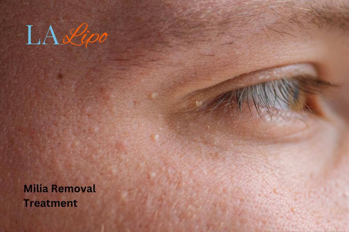 Cryopen Milia Removal: Is It the Easiest and Safest Option Deanshanger?