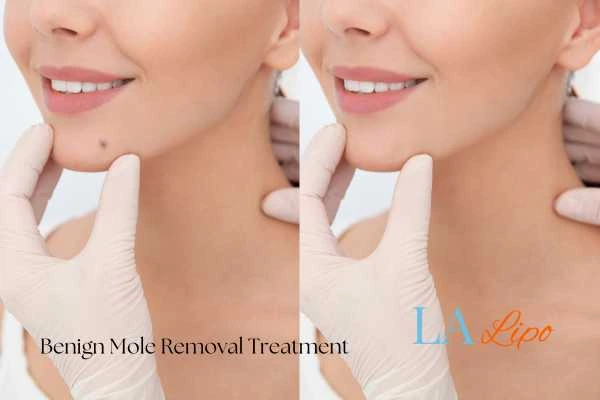 Before-and-after results following benign mole-removal treatment Deanshanger