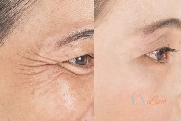 Before and after results of woman - HI-fu wrinkles reduction treatment Deanshanger