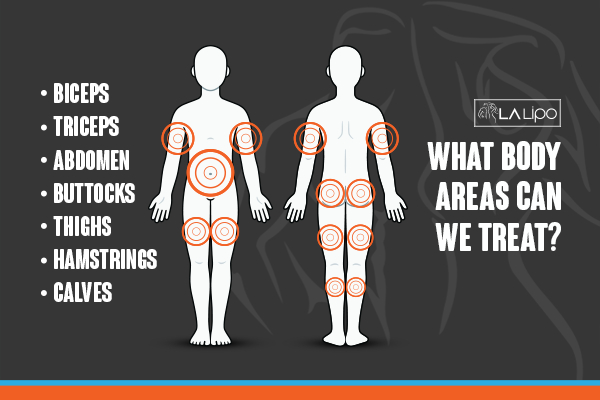 Graphic to show areas you can have LA-EMS Body Sculpting Deanshanger treatment.