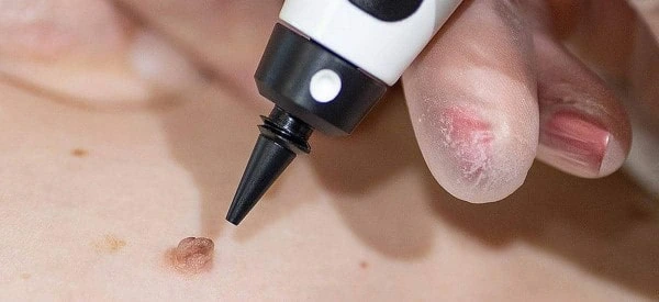 skin tag removal using cryopen Deanshanger