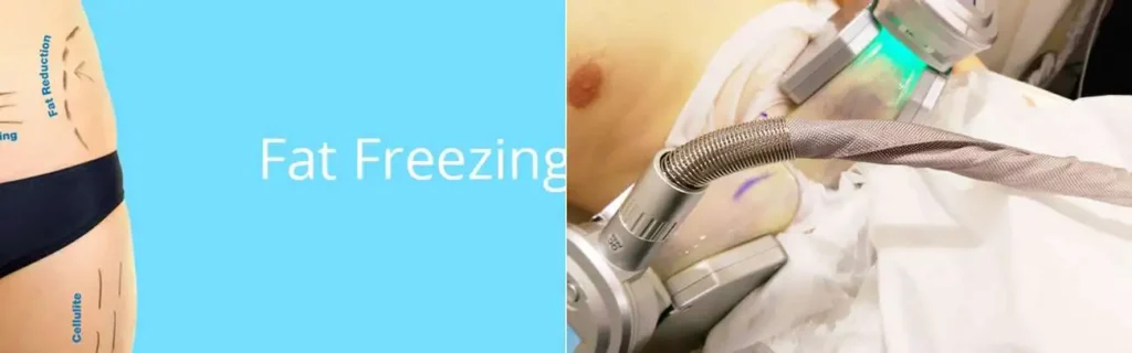 Fat freezing Deanshanger on multiple areas of the body