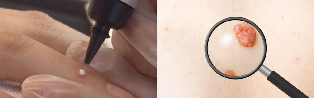CryoPen practitioner Deanshanger assessing a benign mole before treatment