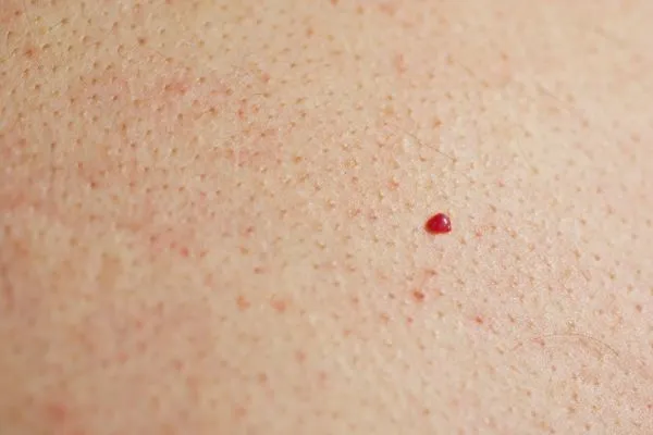 close up of a cherry angioma Deanshanger