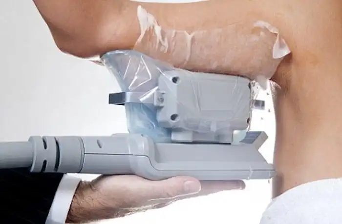 Picture of fat freezing Deanshanger on the upper arms.