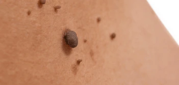 image of a skin tag Deanshanger