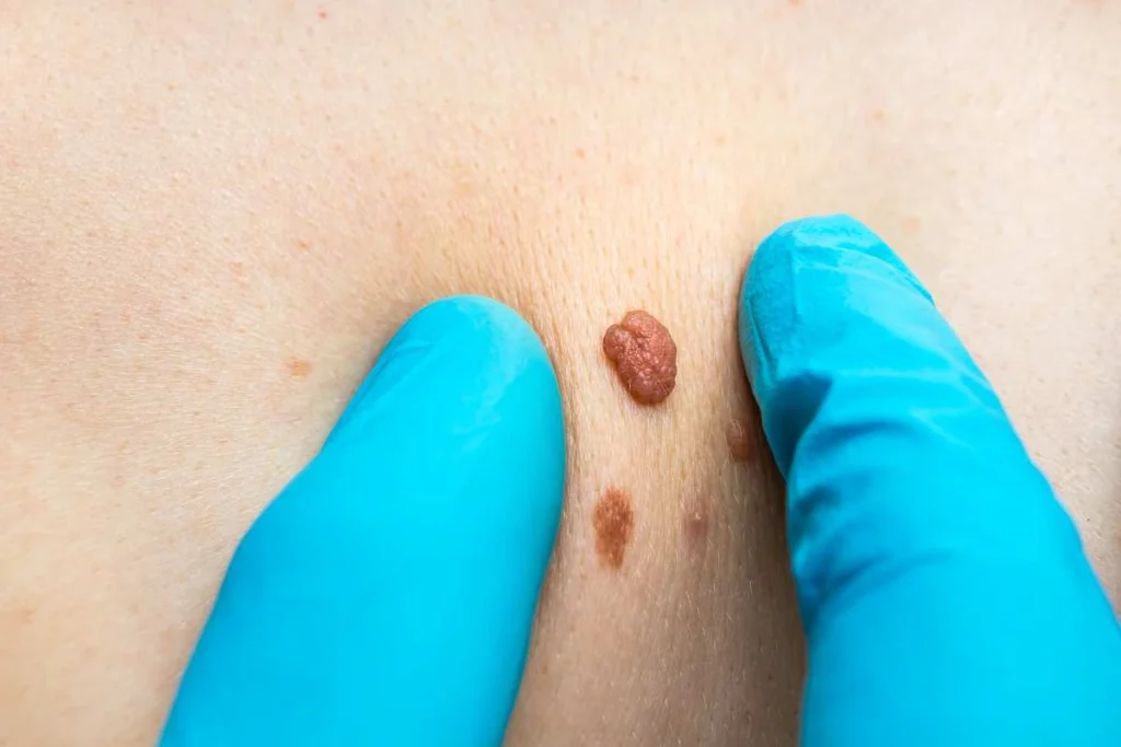 Consultant examining a skin tag Deanshanger