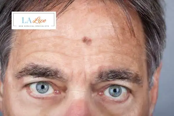 Solar Lentigo Removal Deanshanger image of man with mark on his forehead