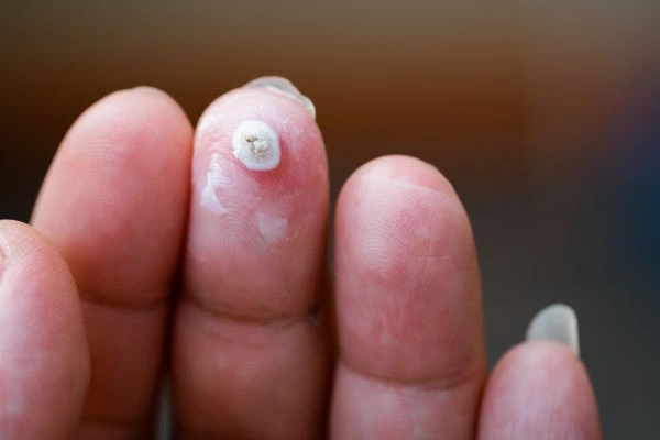 wart on person finger - cryotherapy to treat from LA LIPO Deanshanger