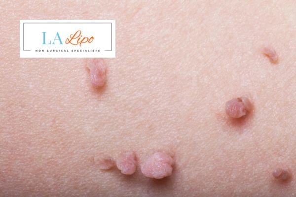 Does cryopen skin tag removal Deanshanger hurt? Find out now call our team today!