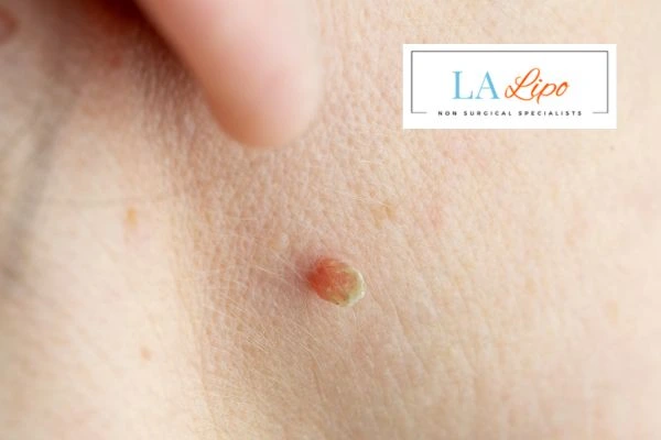 Book skin tag removal Deanshanger today speak to our team now!