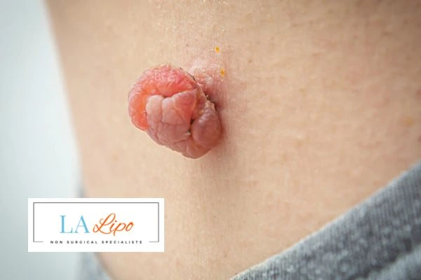 Interested in skin tag removal Deanshanger? Concerned about the pain? Find out more today!