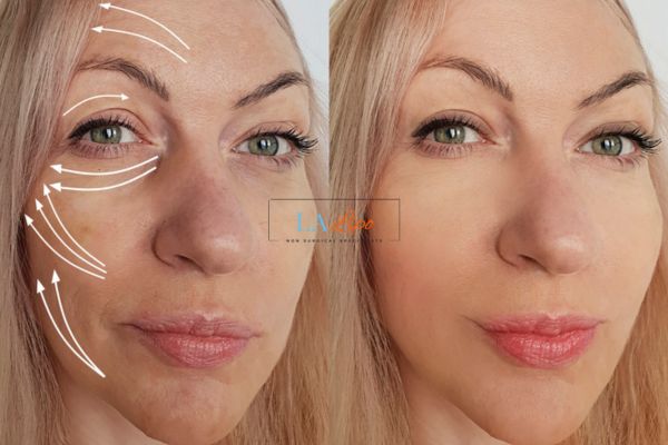Morpheus 8 results Deanshanger face lift.