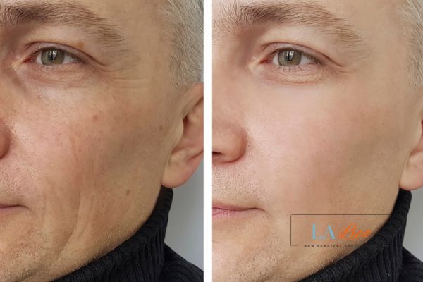 See the amazing results of Morpheus8 Treatment Deanshanger!