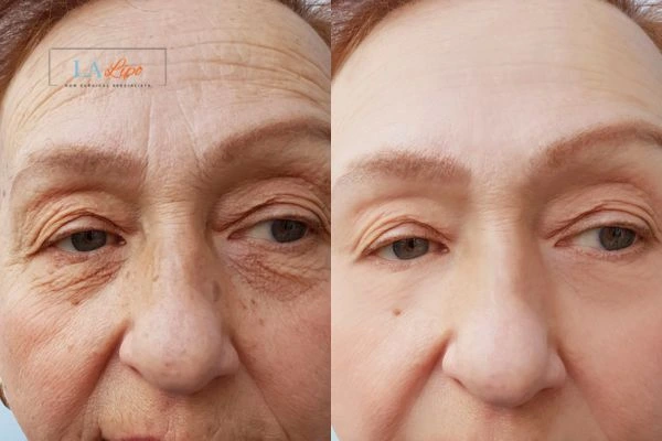 The powerful benefits of Morpheus8 Treatment Deanshanger - Call Our team today!
