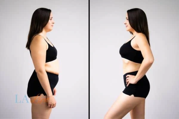 Picture of womans before and after using LA-EMS body sculpting to improve her core strength Deanshanger