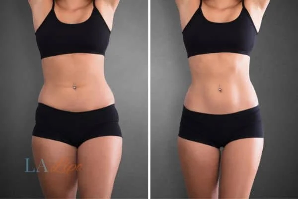 before and after results of non-surgical treatment to help a woman's body image and mental health Deanshanger