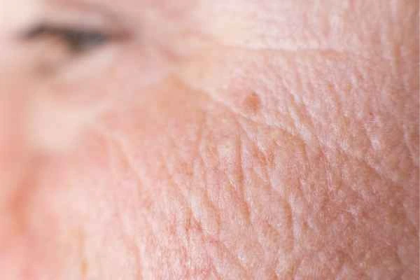 close up picture of a woman's face showing an age spot Deanshanger