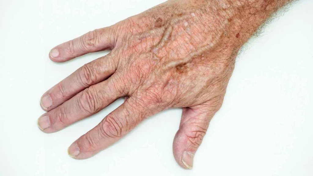 Male hand showing age spot Deanshanger