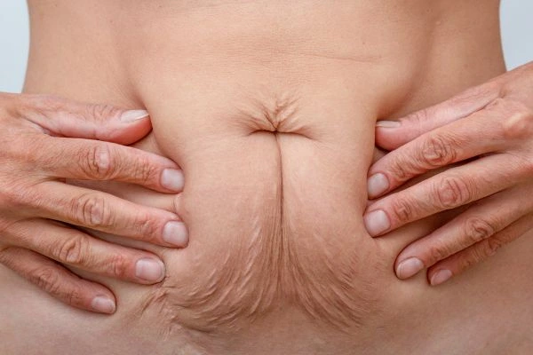 Image of a woman's stomach with loose skin - example of skin tightening Deanshanger options