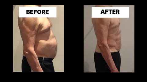 What Symptoms Can Diastasis Recti Cause in Men? Weak Core, Back Pain and Poor Posture Deanshanger